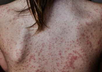 Los brotes de la Psoriasis Pustulosa Generalizada llevan a los pacientes a un total aislamiento en su vida diaria