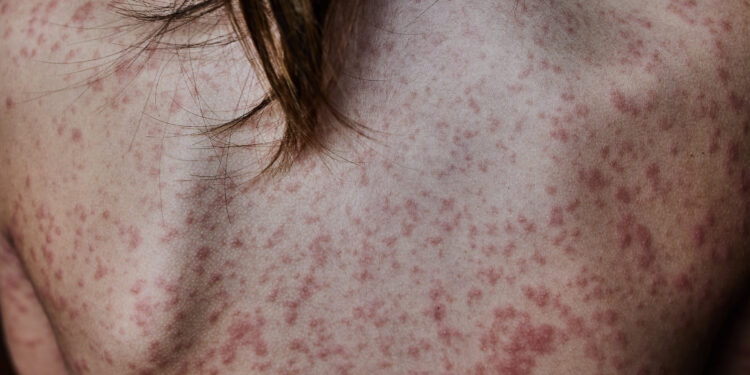 Los brotes de la Psoriasis Pustulosa Generalizada llevan a los pacientes a un total aislamiento en su vida diaria