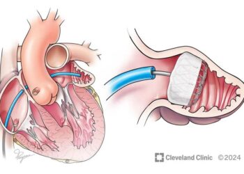 Implante cardíaco podría ser una alternativa para pacientes con fibrilación auricular