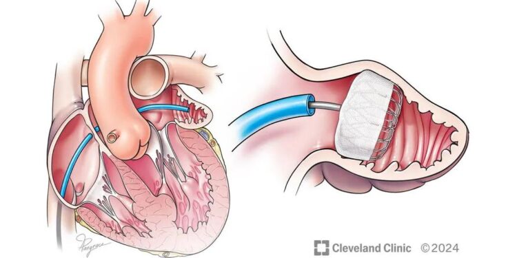 Implante cardíaco podría ser una alternativa para pacientes con fibrilación auricular