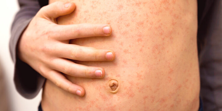 Confirman 4 mil 353 casos y 17 muertes por sarampión en México