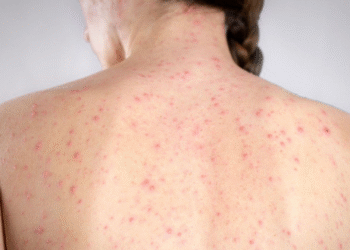 México podría perder su estatus de “zona libre de sarampión”; OPS alerta por brote