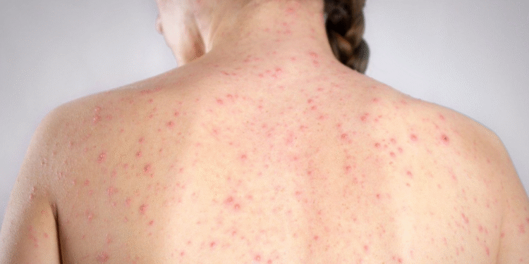 México podría perder su estatus de “zona libre de sarampión”; OPS alerta por brote