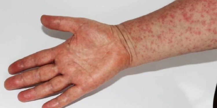 Sarampión en México: fallece niño de un año que no estaba vacunado en Tlaxcala