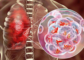 Tuberculosis: detectar a tiempo para frenar una epidemia silenciosa El arte de disfrutar con estilo y sentido.